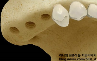 임플란트 뼈이식이 필요한 이유 관련 이미지 2