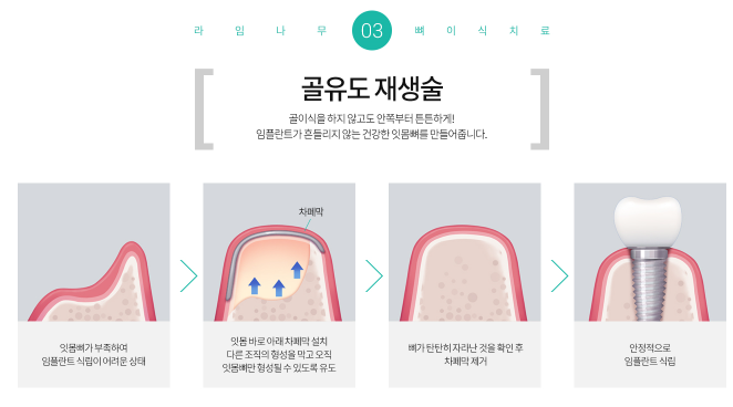 임플란트 기간 얼마나 걸릴까? 임플란트 뼈이식, 임플란트 종류 관련 이미지 4