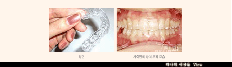 치아교정중에도 밝은 미소로 자신있게 면접보자! 관련 이미지 8