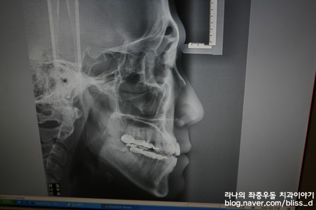 치아교정 가격 보다 치아교정 잘하는 치과 고르기 관련 이미지 5