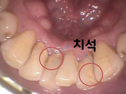 스케일링 전후 사진으로 알아보는 스케일링 효과 관련 이미지 3