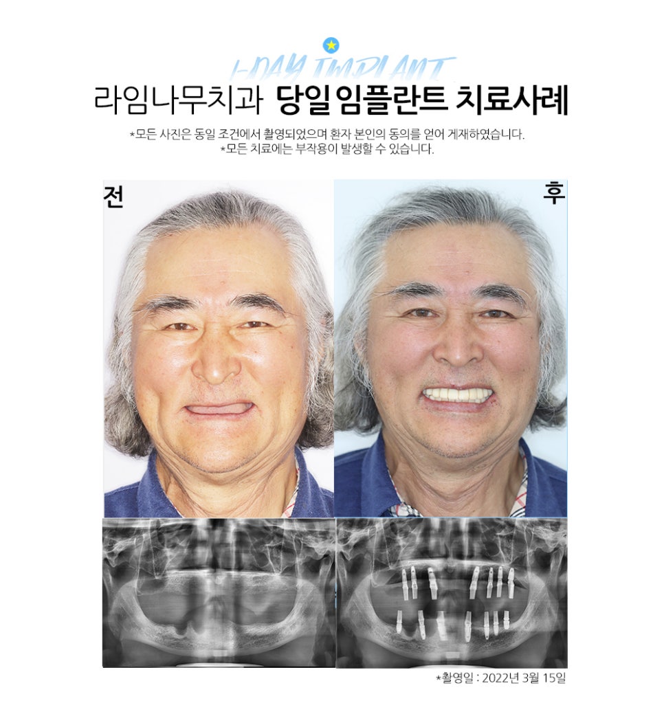 임플란트, 단돈 40만원으로 할 수 있다고요? 관련 이미지 7