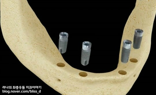 임플란트 틀니가 틀니보다 나은 이유 3가지 관련 이미지 4