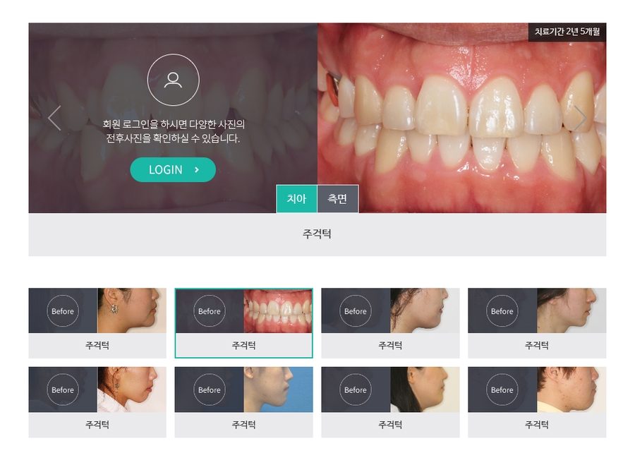 [주걱턱 무턱 돌출입] 치아교정의 선택기준 관련 이미지 9