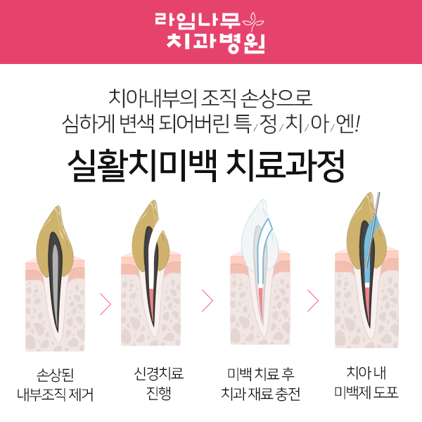 치아미백종류 환한 미소 기대해도 좋아 관련 이미지 3