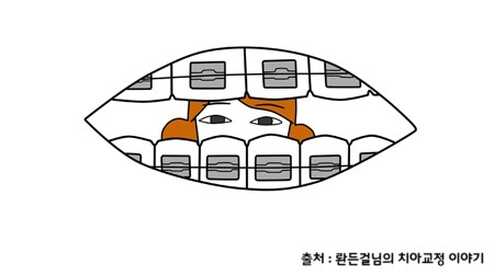 한 눈에 보는 치아교정 - 치아교정 장치의 종류 관련 이미지 6