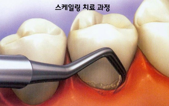 스케일링 건강(의료)보험적용 7월1일부터 시작! 관련 이미지 5