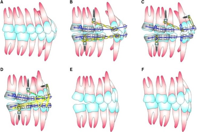 치아교정 종류와 비용 알아보기 관련 이미지 6