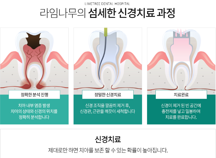 [명동치과] 신경치료 후 통증 이유와 주의사항 알아보기! 관련 이미지 2