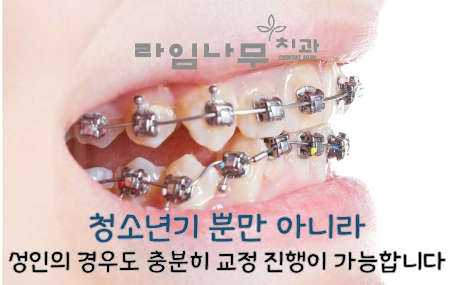 '실버 교정'환자 증가, 언제든지 치아 교정이 가능해요! : 네이버 블로그 관련 이미지 3