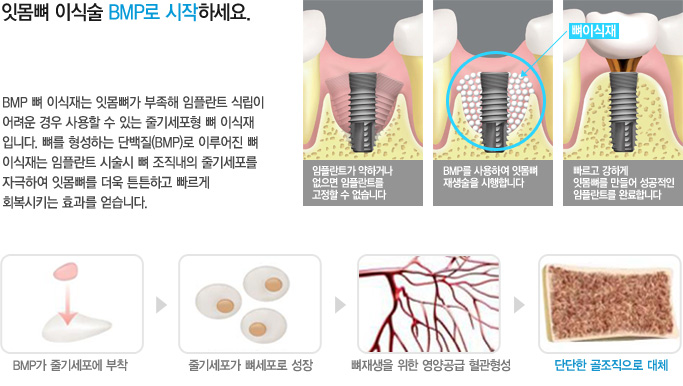 임플란트는? 라임나무치과만의 특화 임플란트 관련 이미지 13