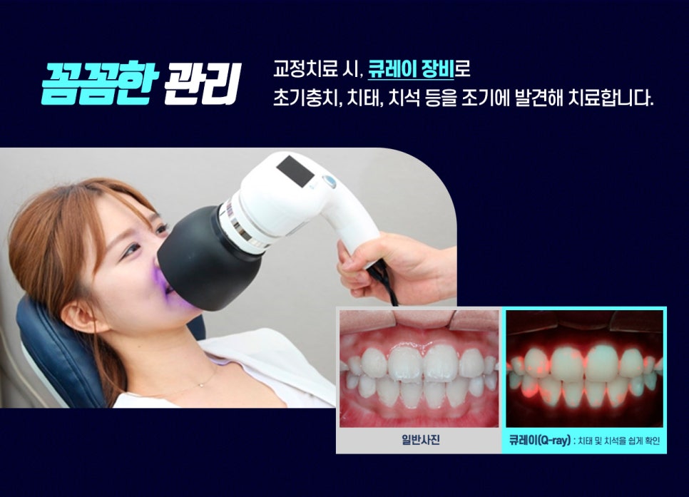 여름방학 맞이 치아교정 이벤트를 실시합니다! 관련 이미지 6