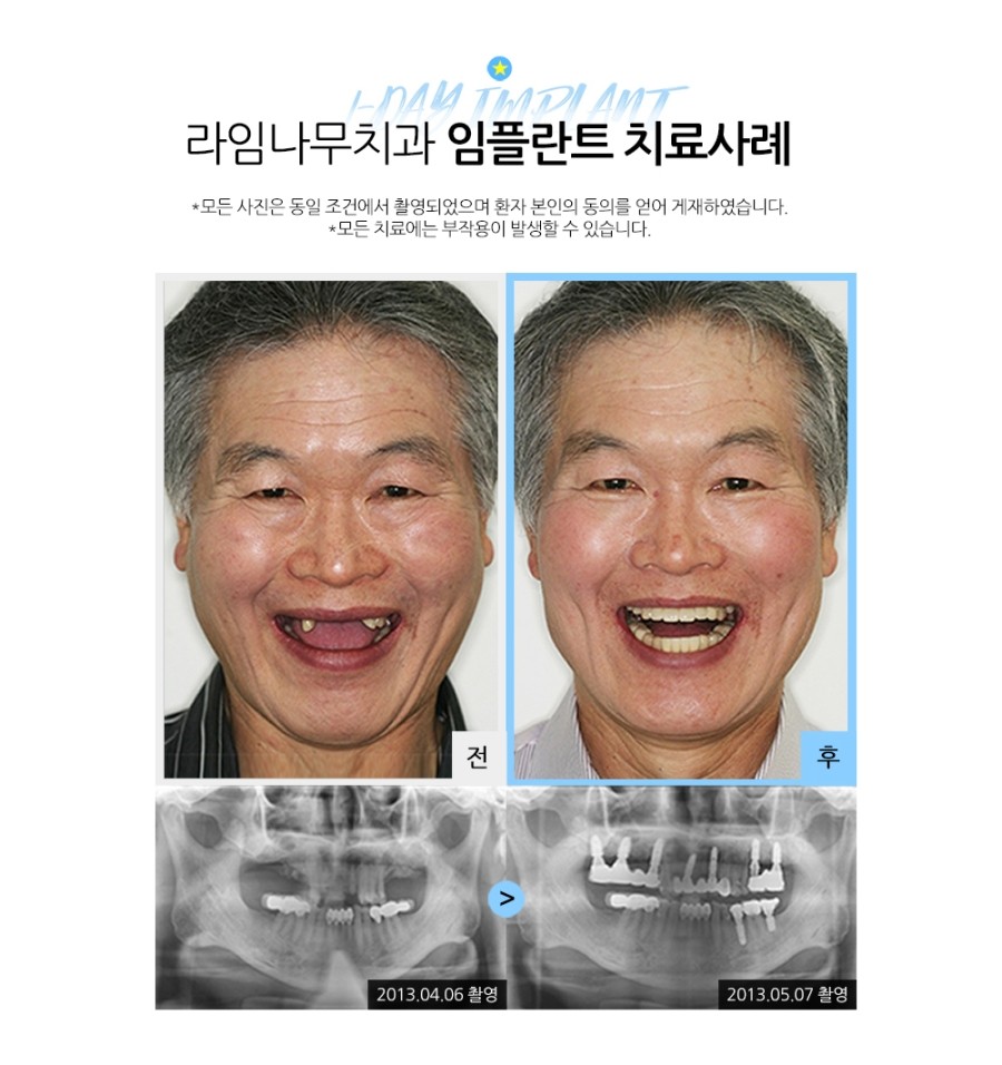 임플란트잘하는곳 라임나무치과병원입니다 관련 이미지 1
