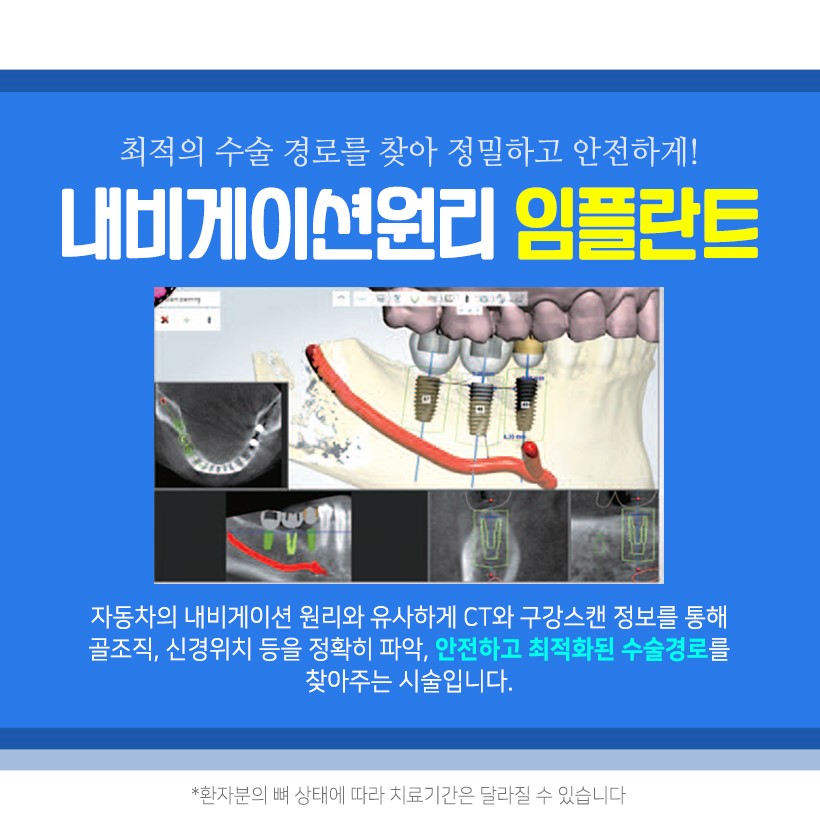 임플란트 비용 걱정 없이 내원 당일에도 가능할까? 관련 이미지 6