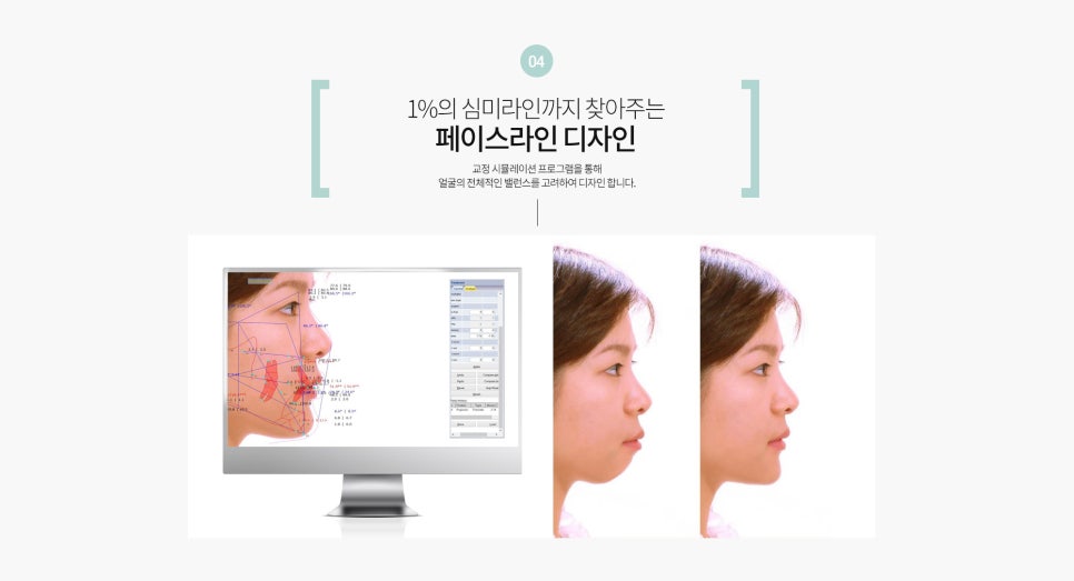 명동치과 클리피씨 교정 궁금하다면? 라임나무치과 관련 이미지 7