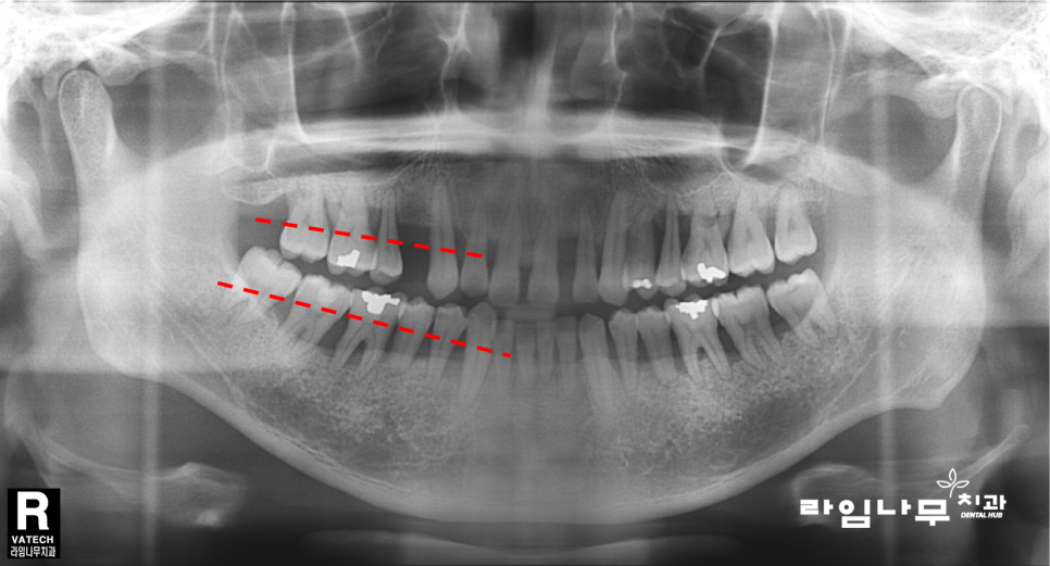 명동치과 전체임플란트 증례! 치주염으로 전체 치아의 기능을 상실한 치아 관련 이미지 4