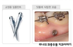 당뇨나 고혈압 등 전신질환 환자들 치아교정 가능할까? 관련 이미지 5