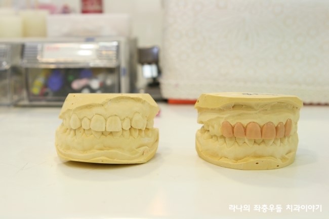 라미네이트 가격 VS 라미네이트 잘하는 명동치과 관련 이미지 3