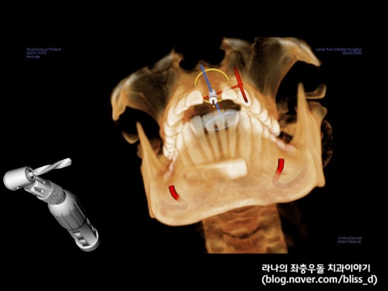 명동임플란트 심미성? 기능성? 어떤 비중을 둬야할까? 관련 이미지 7