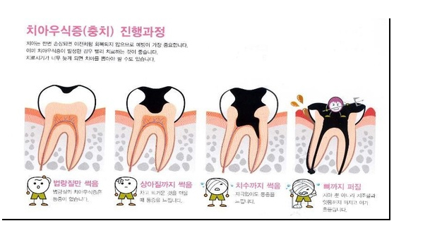 충치의 원인과 치료방법 관련 이미지 4