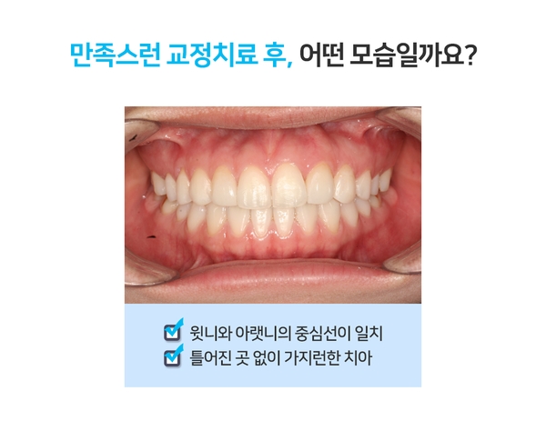 명동치과 라임나무치과에서 몰래 "티안나는교정" 하세요! 관련 이미지 4