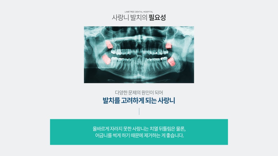 [명동치과] 사랑니 안뽑으면 어떻게 되나요? 신경과 근접한 매복사랑니 발치 가능한 라임나무치과 관련 이미지 3
