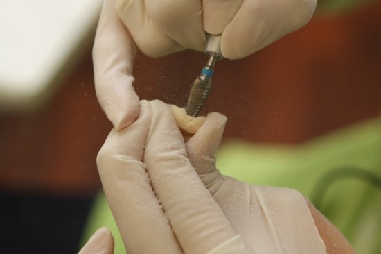 임시치아 제작 테스트 in 라임나무치과병원 관련 이미지 4