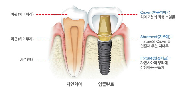 [궁금해요]임플란트의 수명, 얼마나 되나요? 관련 이미지 2