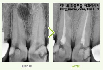 신경치료 통증을 잡는 명동치과 관련 이미지 3