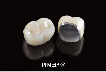 치아를 씌우는 크라운 보철치료! PFM크라운? 지르코니아? 어떤 종류가 있나요? 관련 이미지 4