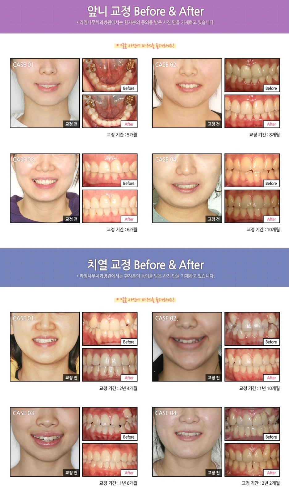 [명동치과]돌출입 때문에 고민중이시라고요? 라임나무에서 교정하세요 관련 이미지 13
