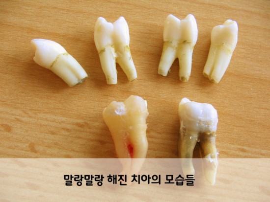 콜라가 치아건강에 미치는 영향 관련 이미지 2