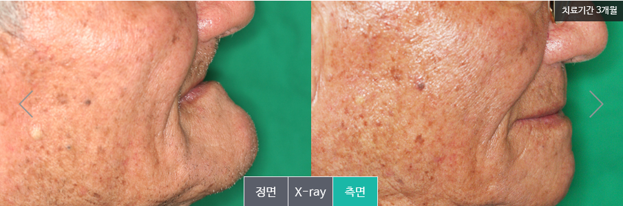 명동치과 만족도 높은 임플란트 틀니 알아보기! 라임나무 관련 이미지 5