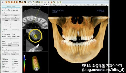 명동임플란트 심미성? 기능성? 어떤 비중을 둬야할까? 관련 이미지 8