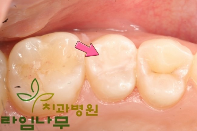 명동치과 라임나무가 알려드리는 어린이 치아상식 관련 이미지 3