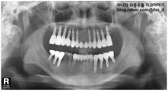 임플란트 치료시 x-ray, ct 촬영이 필요한 이유 관련 이미지 5