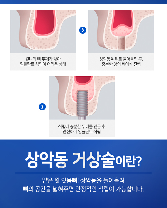 오스템임플란트비용 합리적으로 가능합니다 관련 이미지 8