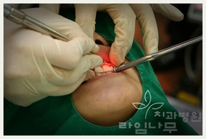 앞니에 충치가 생겼을 때의 다양한 치료 방법 관련 이미지 1