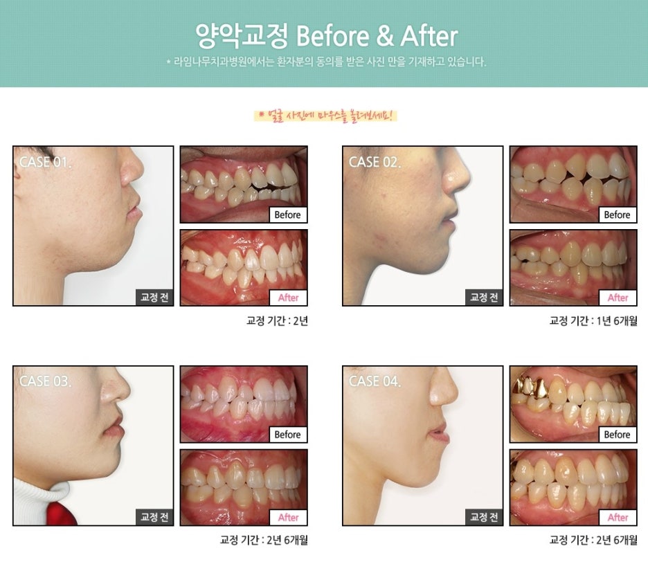 [명동치과]돌출입 때문에 고민중이시라고요? 라임나무에서 교정하세요 관련 이미지 7