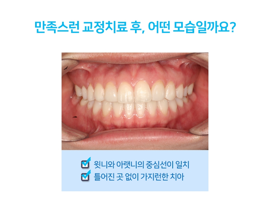 [주걱턱 무턱 돌출입] 치아교정의 선택기준 관련 이미지 4