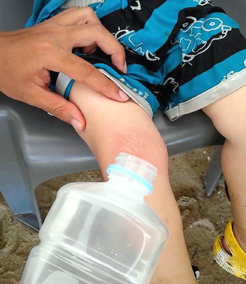 [명동치과 라임나무]해파리에 쏘였을 때 응급처치법을 알아보았습니다 관련 이미지 3