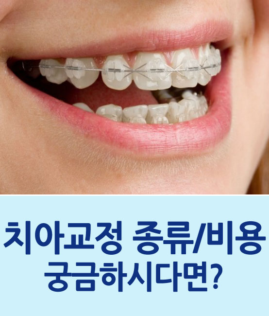 치아교정 종류와 비용 알아보기 관련 이미지 1