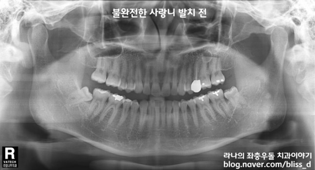 사랑니 발치 잘하는 명동치과 어디? 관련 이미지 5