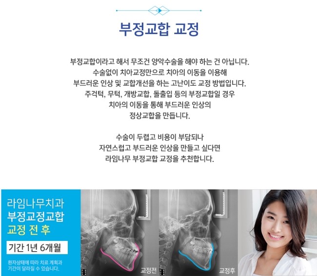부정교합 고민 치아교정으로 해결하세요 관련 이미지 3