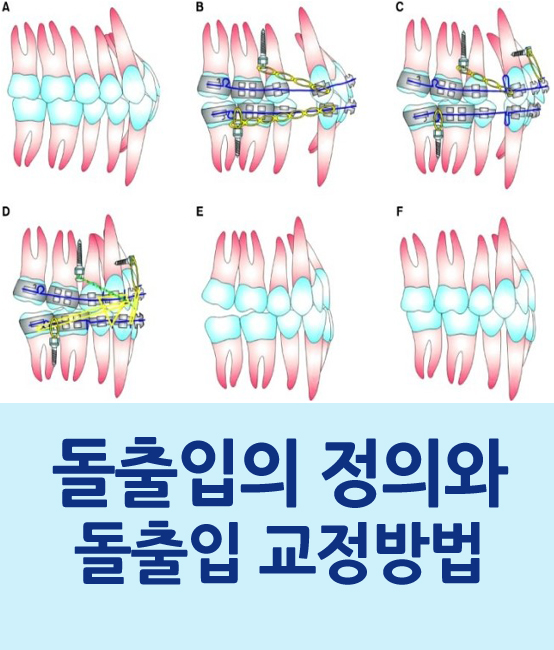 돌출입의 정의와 돌출입 교정방법 관련 이미지 1