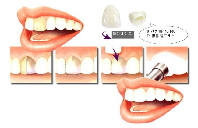 라미네이트 부작용 궁금하신가요? 관련 이미지 3