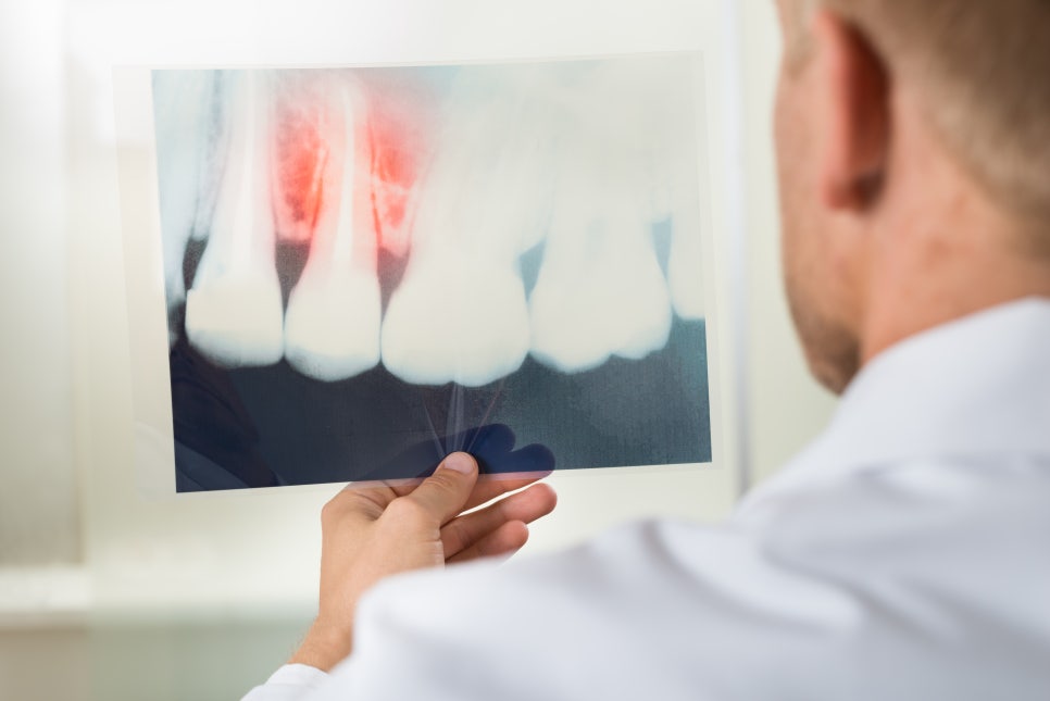 싼게 비지떡? 실패한 임플란트? NO! 라임나무치과병원 OK 관련 이미지 8