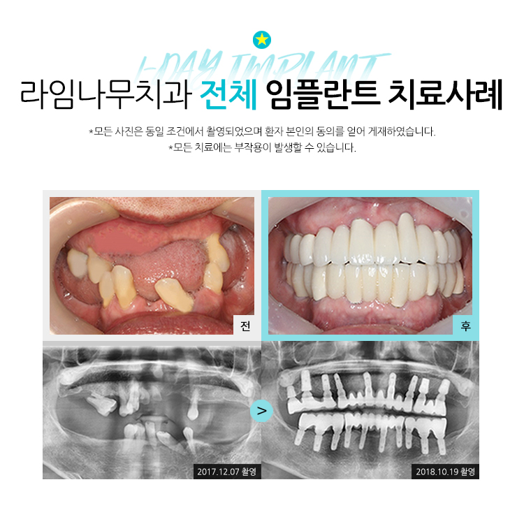 무치악임플란트 알아보고 계신다면? 라임나무치과에서 상담 받으세요! 관련 이미지 10