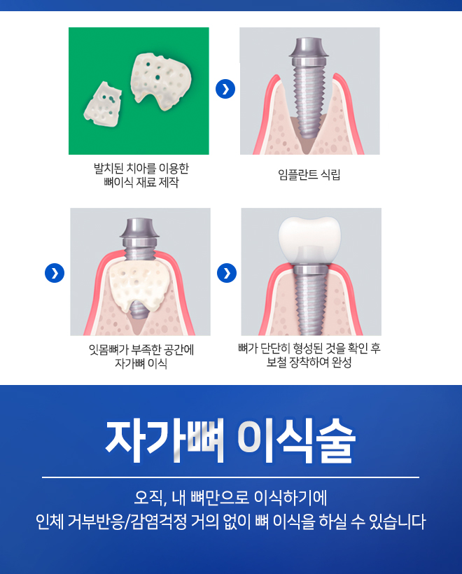 오스템임플란트비용 합리적으로 가능합니다 관련 이미지 9