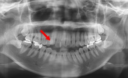 덧니의 정의와 덧니 교정방법 관련 이미지 8